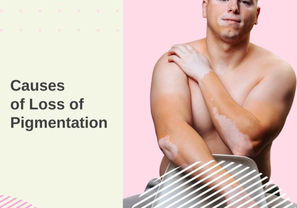Causes of Loss of Pigmentation